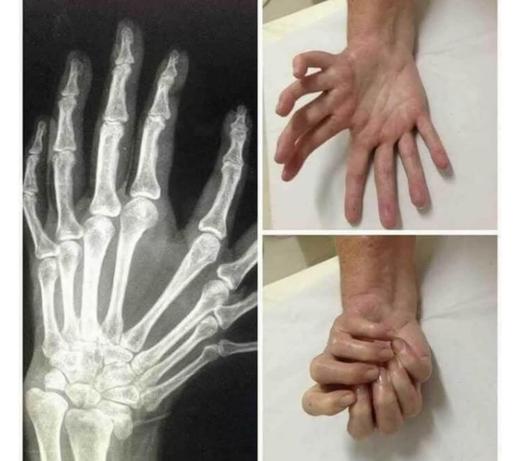 در این اختلال دست ها به صورت آینه ای به یدیگر چسبیده اند. گفته می شود در جهان کمتر از 100 موردمشاهده شده است.