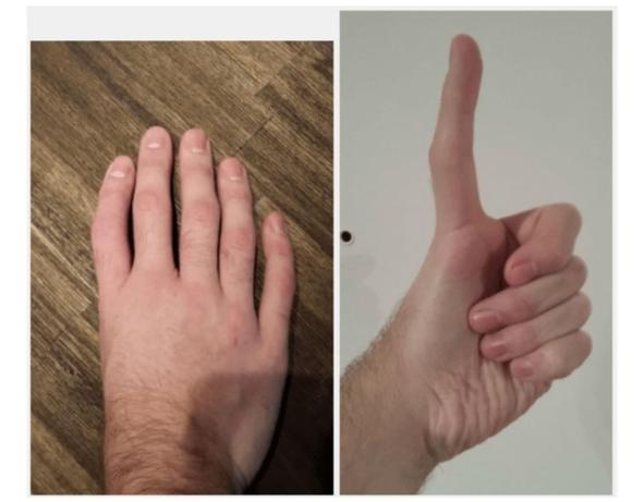 این شخص بلندترین انگشت شست دنیا را دارد.