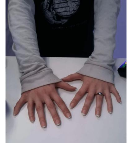 هر دست این زن به طور عجیبی 6 انگشت دارد.