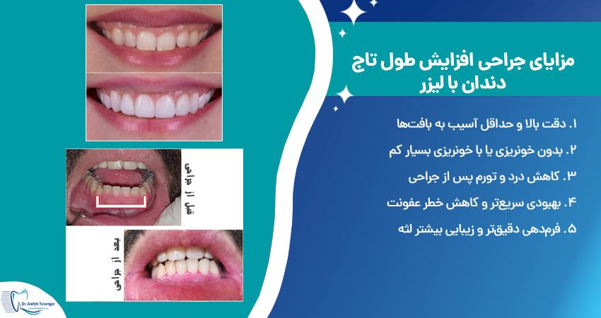 مزایای استفاده از لیزر در جراحی لیفت لثه و دندان