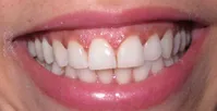 شش وضعیتی که توجیه کننده خونریزی لثه‌ها هستند