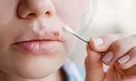 چطور خطر انتشار ویروس تبخال را کاهش دهیم؟