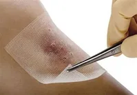 همه چیز درباره بیماری "سیاه زخم"