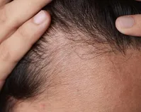 درمانی جدید برای ریزش مو