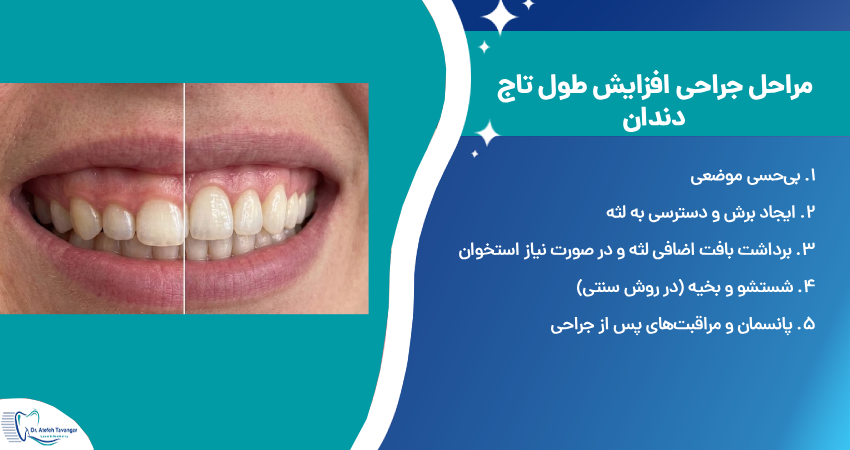 مراحل جراحی افزایش طول تاج دندان