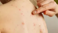 ابتلای ۹۶ نفر به سرخک در کشور