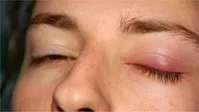علل کیست‌های چربی در چشم و راه‌های درمان آنها