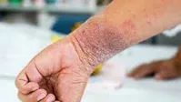 بین اگزما و اضطراب رابطه نزدیکی وجود دارد