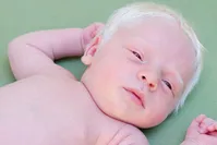 هر آنچه باید در مورد آلبینیسم یا زالی بدانید