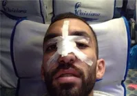 عکسی از بینی شکسته هافبک استقلال در بازی با ملوان