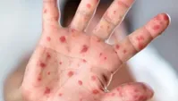 زنگ خطر شیوع سرخک در یزد به صدا درآمد