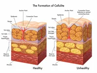 سلولیت را با روش‌های زیر از بین ببرید