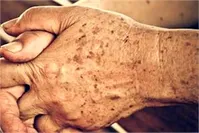 لکه‌ها پوستی از کجا می‌آیند؟