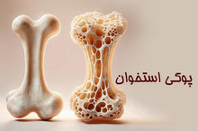 فراگیر شدن پوکی استخوان در کشور