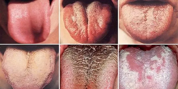 رنگ زبان شما چه هشداری درباره سلامت بدنتان می&zwnj;دهد؟