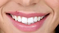 چند توصیه بهداشتی درباره تبخال