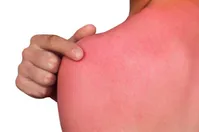 آفتاب سوختگی؛ از تاول تا سرطان پوست