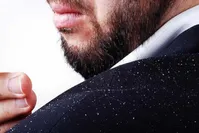 ۱۰ درمان خانگی برای رفع شوره سر