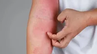 چطور از شر خارش و التهاب در فصل بهار خلاص شویم؟