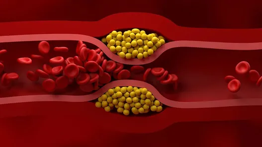 راهنمای پیشگیری از سکته‌های قلبی و مغزی؛ کاهش کلسترول بد