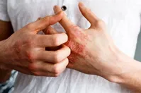علل، علایم و درمان اگزمای آلرژیک
