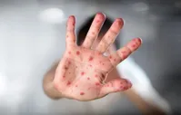 سرخک چقدر خطرناک است؟