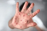 هرآنچه باید راجع به «آبله میمونی» بدانید